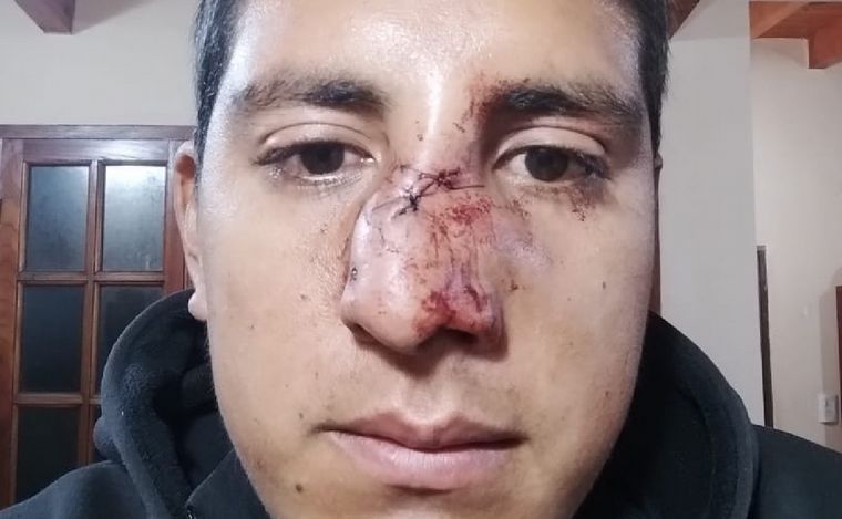 AUDIO: Sanción ejemplar para un futbolista que le fracturó la nariz a un árbitro en Salta